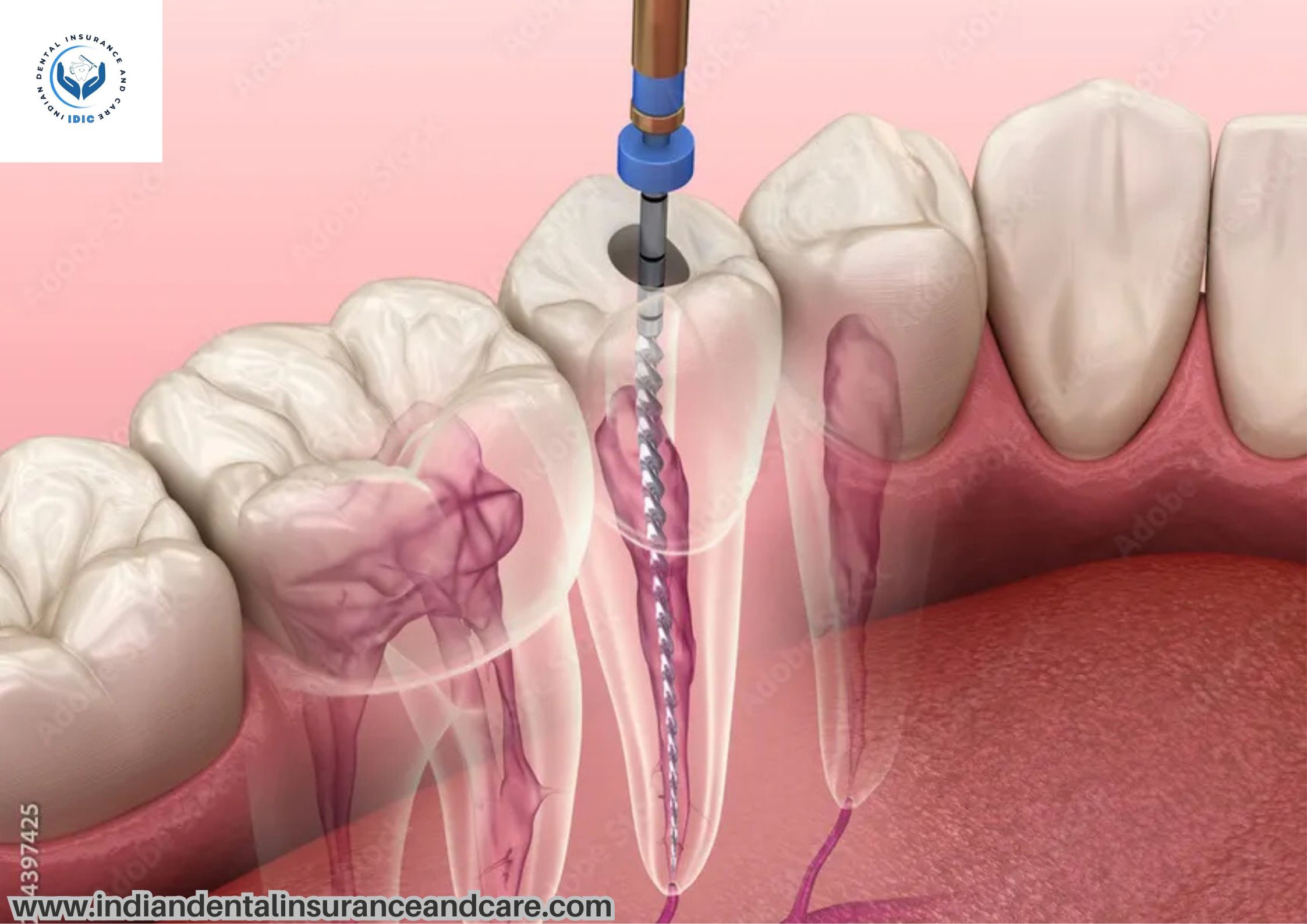 Root Canal Treatment: Everything You Need to Know